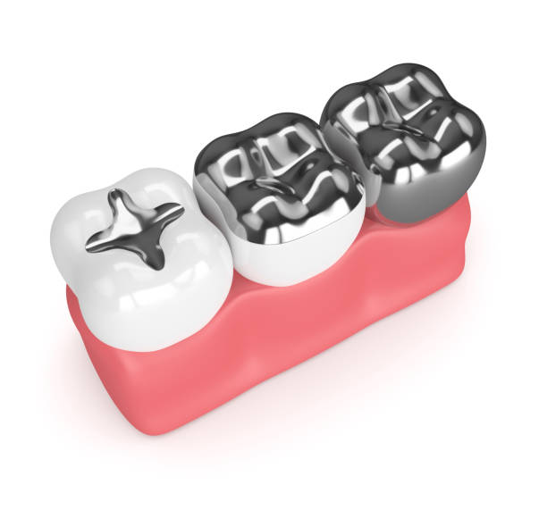 istock 3d render of teeth with different types of amalgam filling 922286534