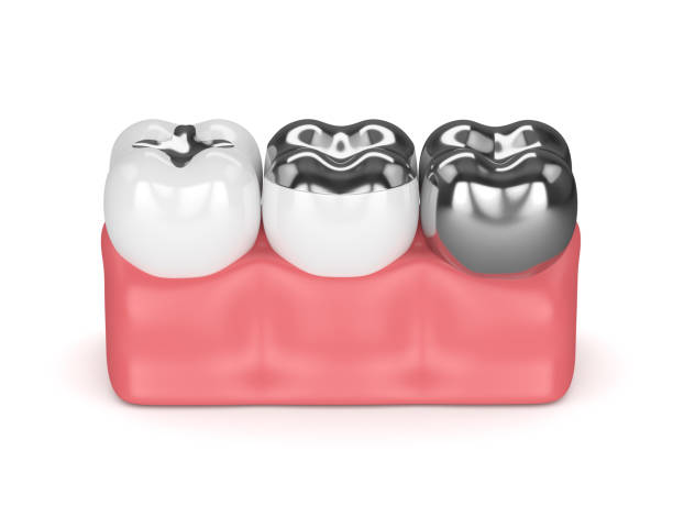 istock 3d render of teeth with different types of amalgam filling 922291882
