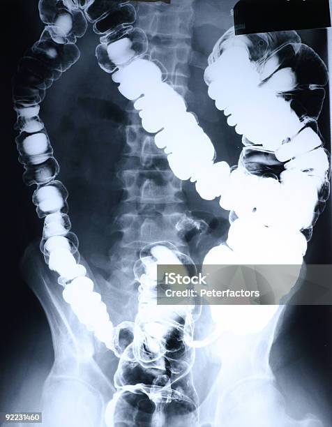 X선 콜론 쇼크에 대한 스톡 사진 및 기타 이미지 - 쇼크, 엑스레이 이미지, X-레이