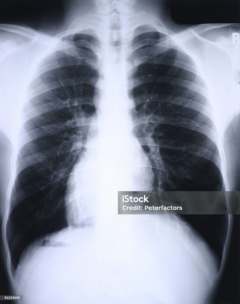 Xray 肺） - MRI検査のロイヤリティフリーストックフォト
