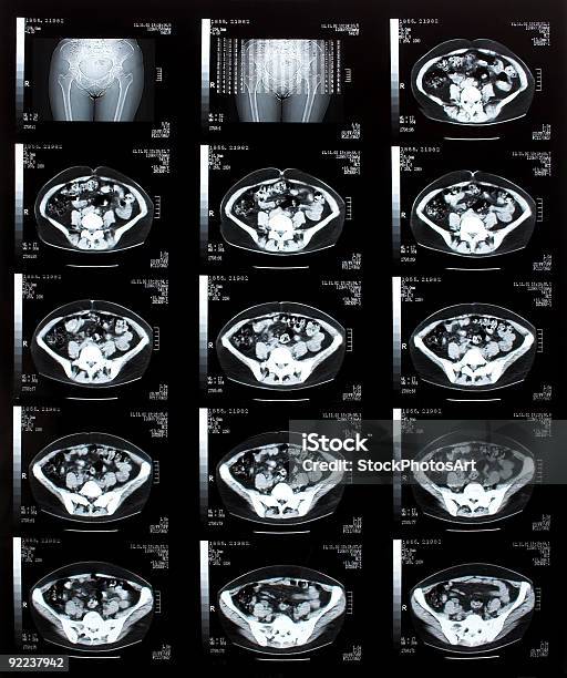 Foto de Broken Pélvis e mais fotos de stock de Exame de ressonância magnética - Exame de ressonância magnética, Pélvis, Mulheres