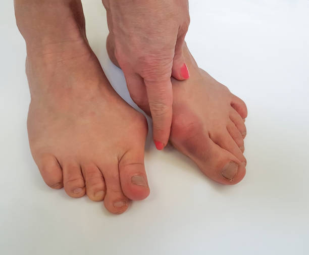 istock valgus female leg on a white background 922413568