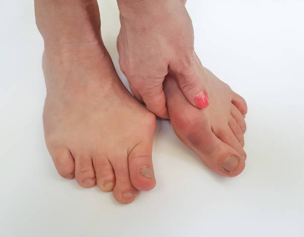 istock valgus female leg on a white background 922414166
