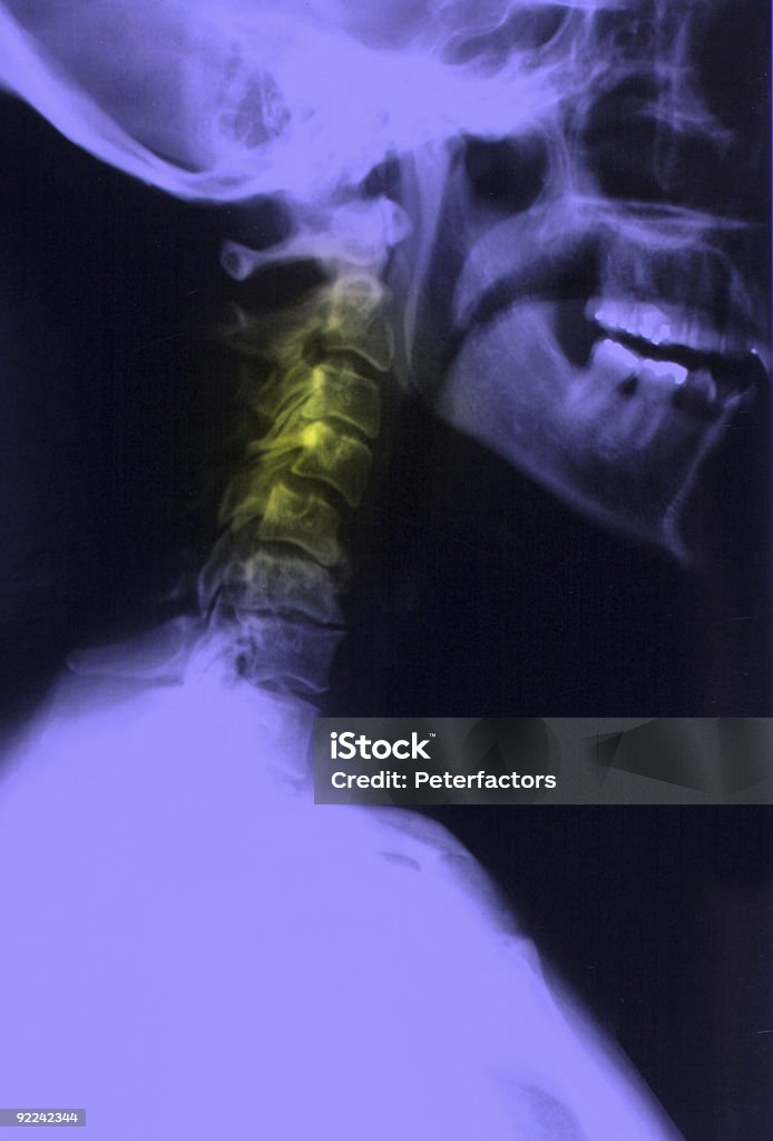 Xray / neck pain  Anatomy Stock Photo