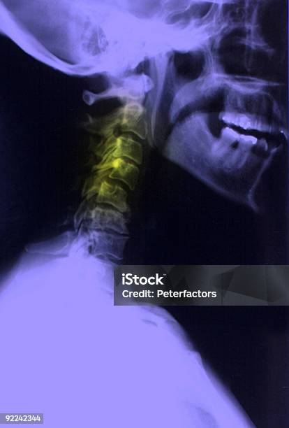 Xray Neck Pain Stock Photo - Download Image Now - Anatomy, Body Care, Cervical Vertebrae