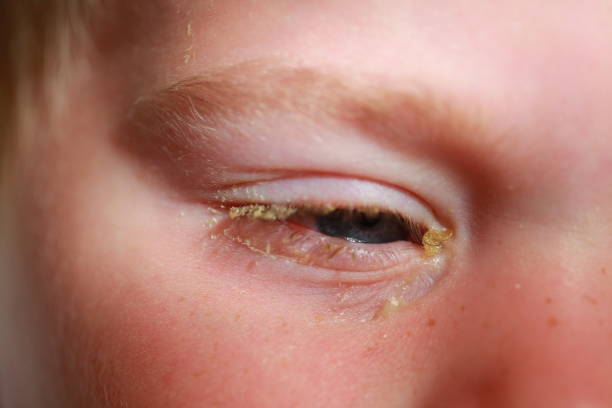 istock purulent conjunctivitis in children 922523276
