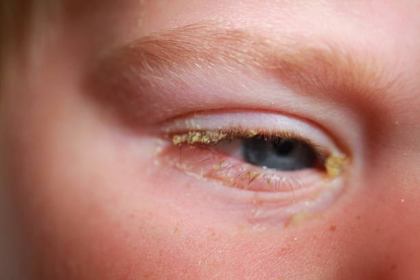 istock purulent conjunctivitis in children 922523330