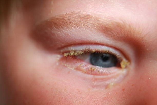 istock purulent conjunctivitis in children 922523370