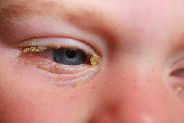 istock purulent conjunctivitis in children 922523406