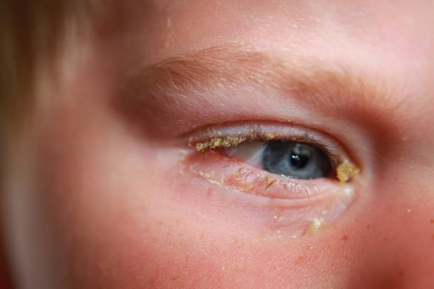 istock purulent conjunctivitis in children 922523408