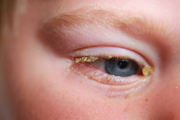 istock purulent conjunctivitis in children 922523416