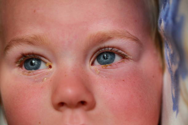 istock purulent conjunctivitis in children 922523516