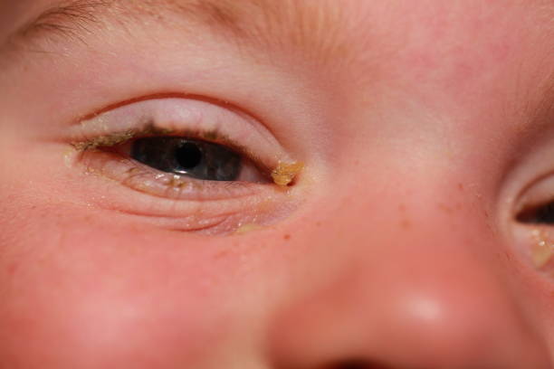 istock purulent conjunctivitis in children 922523560