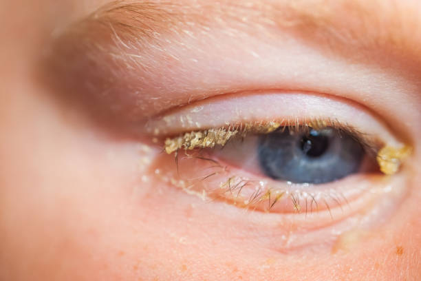 purulent conjunctivitis in children stock photo