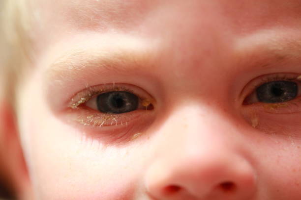 istock purulent conjunctivitis in children 922523620