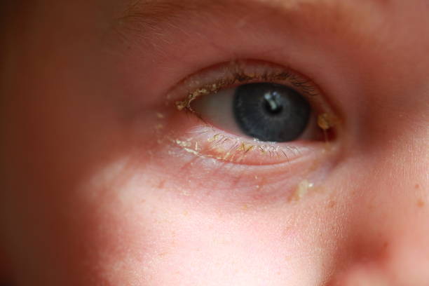 istock purulent conjunctivitis in children 922523626