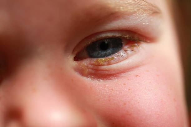istock purulent conjunctivitis in children 922523640