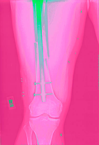 Radiografie del femore la riparazione di frattura - foto stock