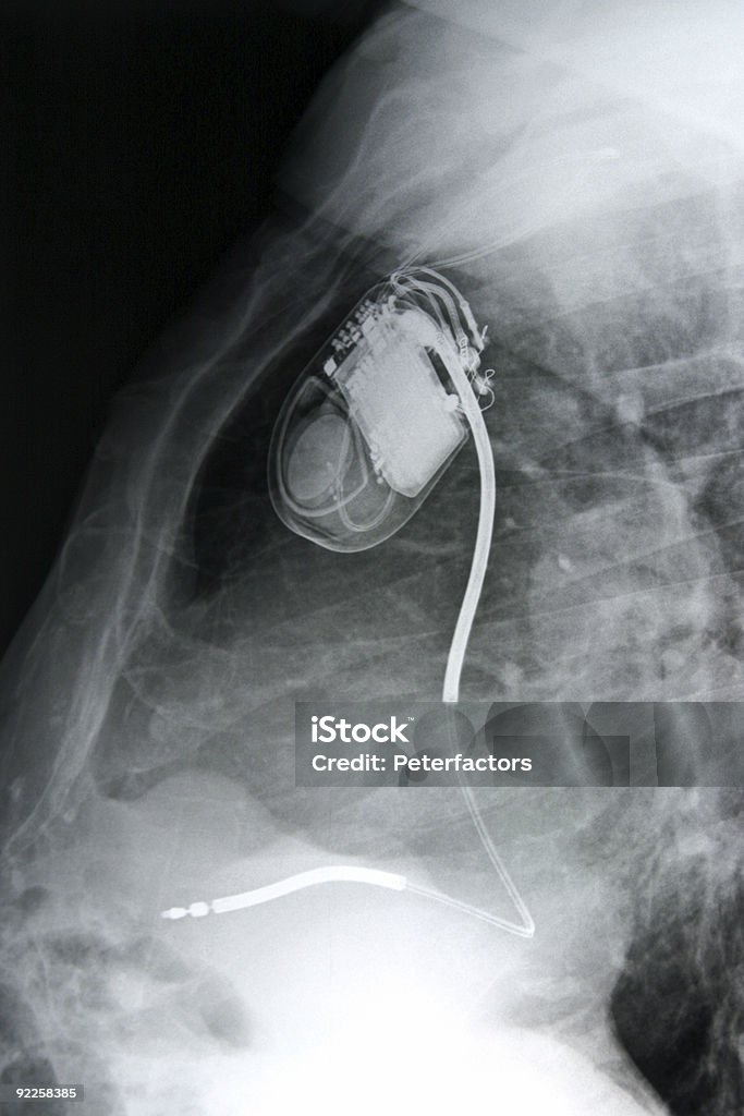 Poitrine Stimulateur cardiaque - Photo de Anatomie libre de droits