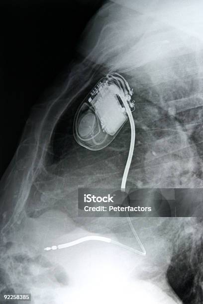 상장형 박동조율기 X-레이에 대한 스톡 사진 및 기타 이미지 - X-레이, 간호사, 건강 진단