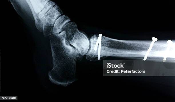 Tornozelo Vista Lateral - Fotografias de stock e mais imagens de Parafuso - Parafuso, Anatomia, Articulação humana