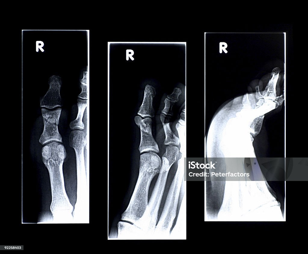 브로컨 엄지발가락 - 로열티 프리 X-레이 스톡 사진