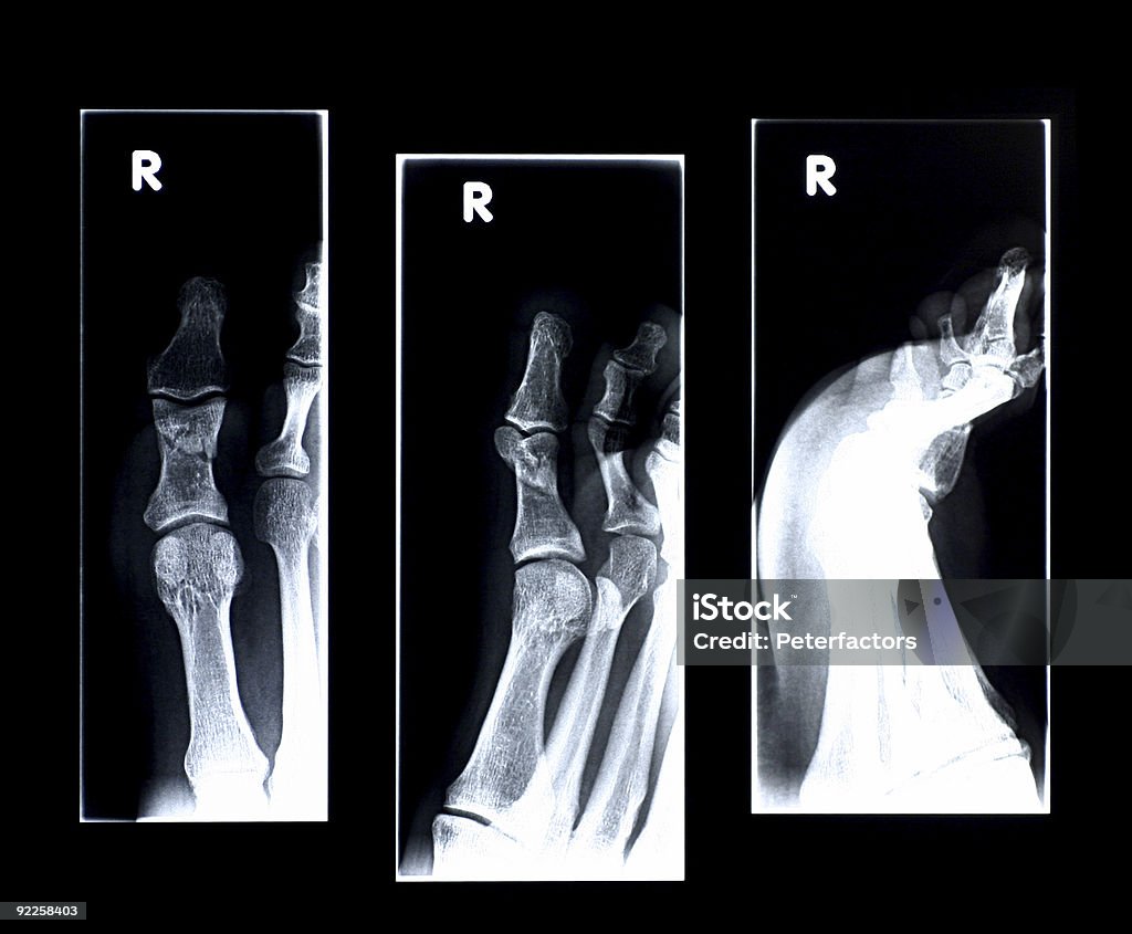 Сломанный большой палец - Стоковые фото Анатомия роялти-фри