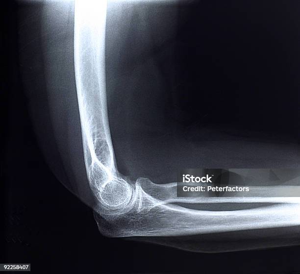 Elbowside View Stock Photo - Download Image Now - Elbow, X-ray Image, Anatomy