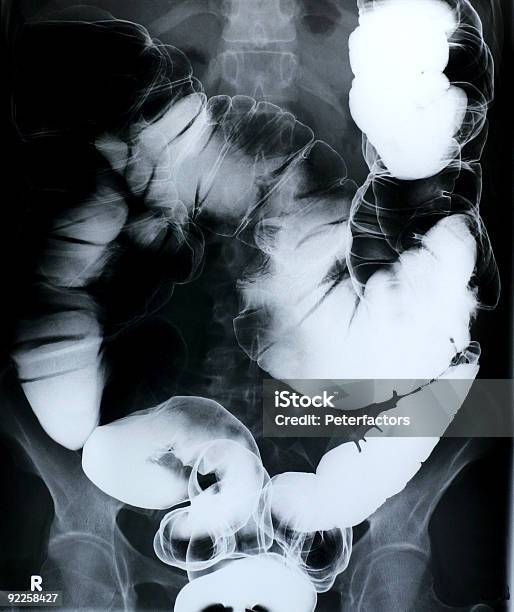 Colon Di Grandi - Fotografie stock e altre immagini di Anatomia umana - Anatomia umana, Apparato digerente umano, Chirurgo