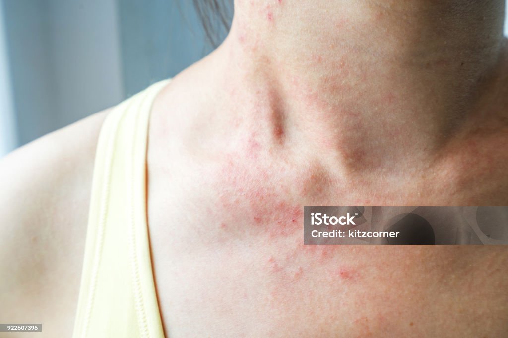 Young woman has skin rash itch on neck Eczema Stock Photo