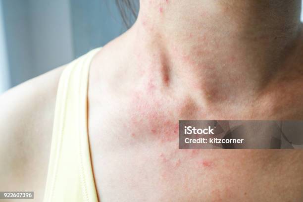 Young Woman Has Skin Rash Itch On Neck Stock Photo - Download Image Now - Eczema, Skin Condition, Skin