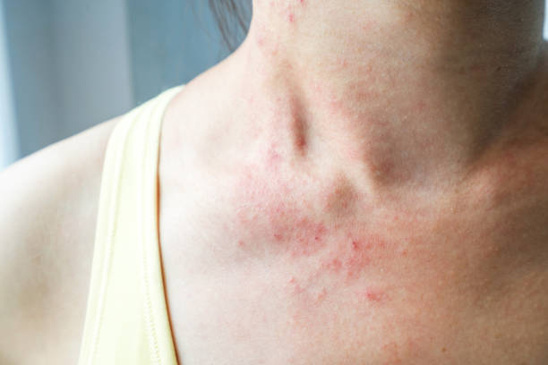 young woman has skin rash itch on neck - frieiras imagens e fotografias de stock