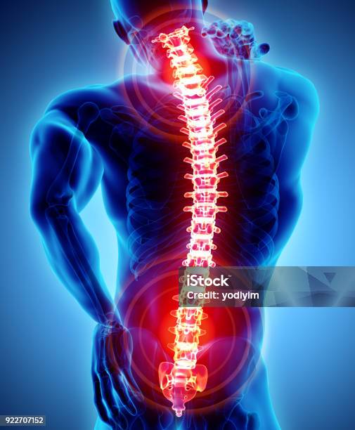 Illustrazione 3d Di Doloroso Sacrale E Cervicale - Fotografie stock e altre immagini di Spina dorsale - Parte del corpo - Spina dorsale - Parte del corpo, Mal di schiena, Dolore fisico