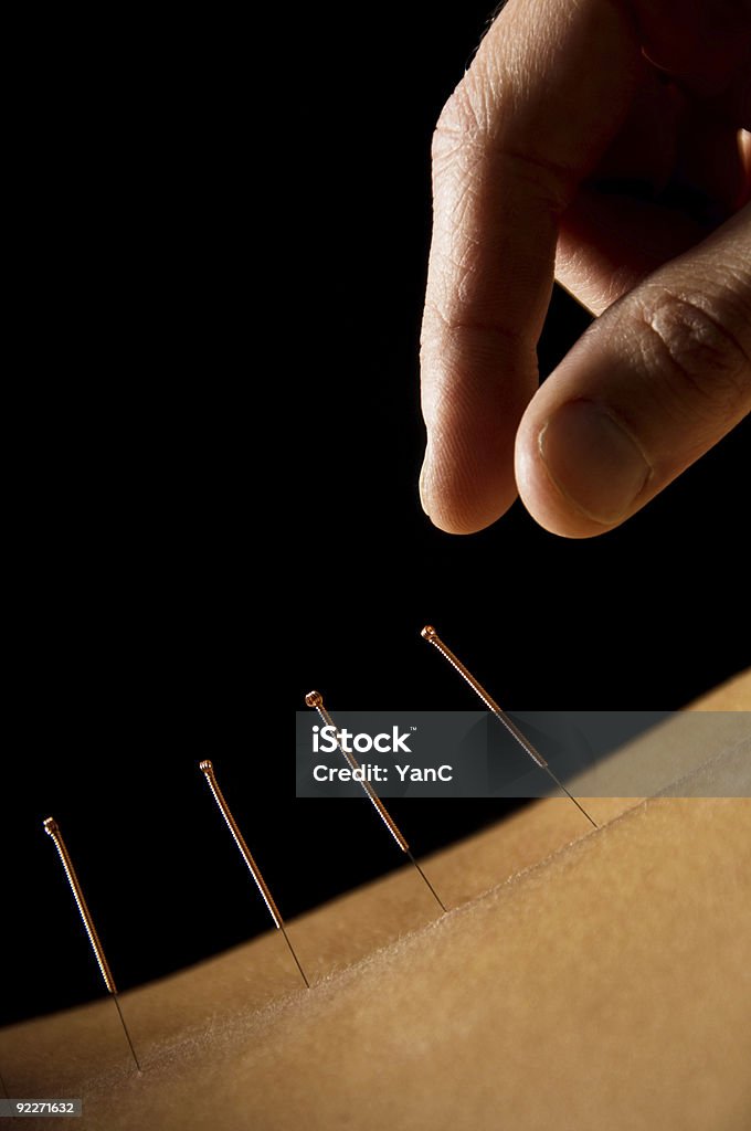 A hand placing acupuncture pins on someone's skin Woman getting an acupuncture treatment in a spa Acupuncture Stock Photo