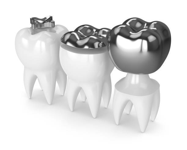 istock 3d render of teeth with different types of amalgam filling 922746452