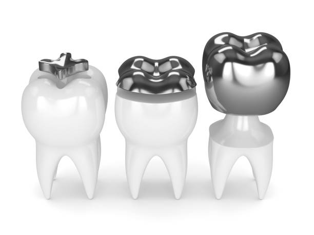 istock 3d render of teeth with different types of amalgam filling 922747250