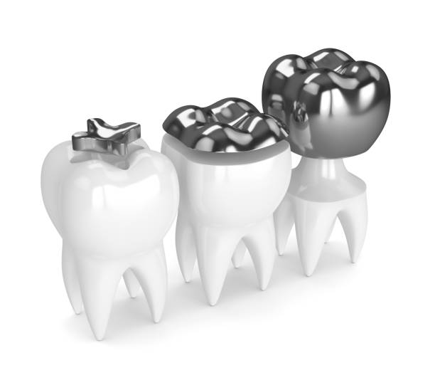 istock 3d render of teeth with different types of amalgam filling 922747632
