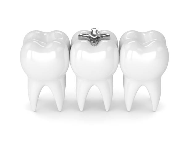 istock 3d render of teeth with dental amalgam filling 922753170