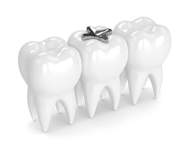 istock 3d render of teeth with dental amalgam filling 922753458