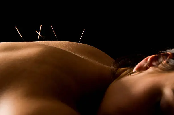 Woman getting an acupuncture treatment in a spa