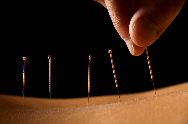 acupuntura - acupuncture needle fotografías e imágenes de stock