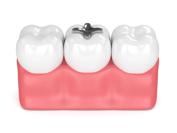 istock 3d render of teeth with dental amalgam filling 922780794