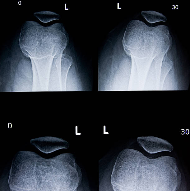 genou x-ray - x ray human knee orthopedic equipment human bone photos et images de collection