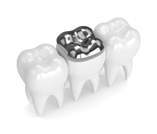 istock 3d render of teeth with dental onlay amalgam filling 923246716