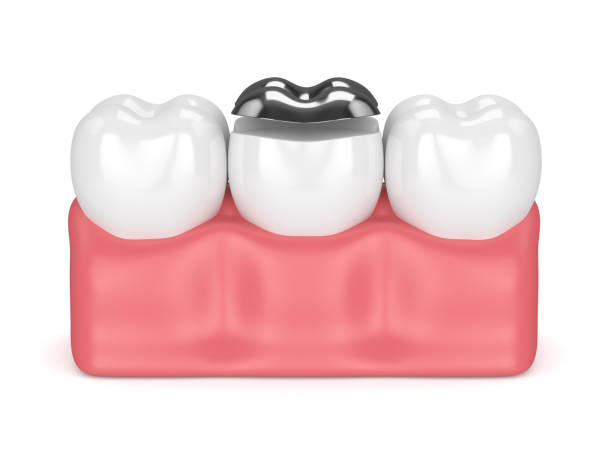 istock 3d render of teeth with dental onlay amalgam filling 923251866