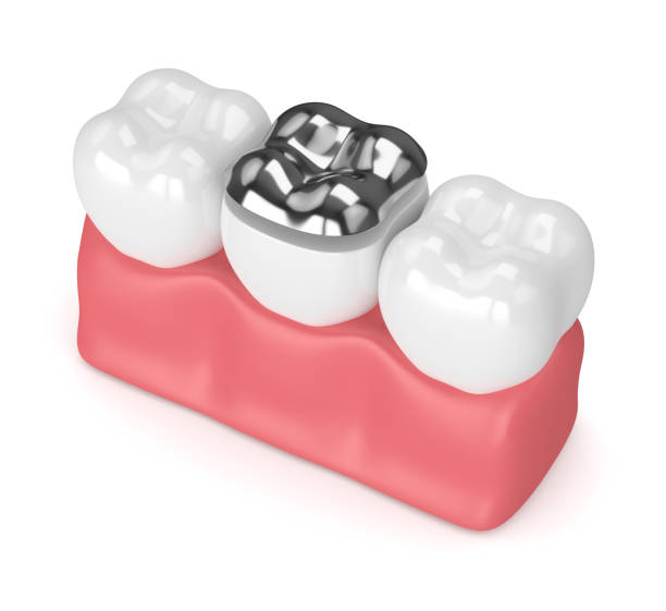 istock 3d render of teeth with dental onlay amalgam filling 923252104
