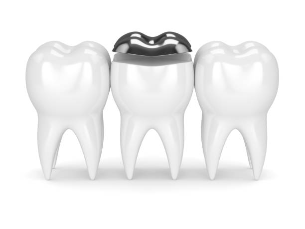 istock 3d render of teeth with dental onlay amalgam filling 923252268