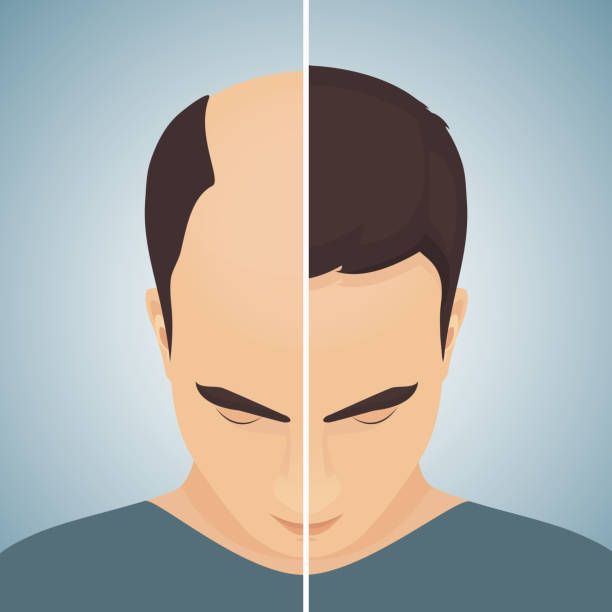 kuvapankkikuvitukset aiheesta hiustenlähtö miehillä - ennen konseptin jälkeen - receding hairline