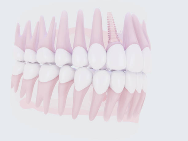 istock Dental implant 923402440