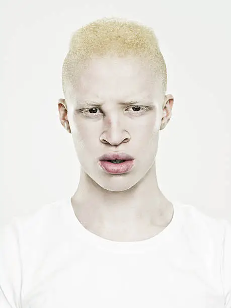 Photo of Headshot of a young albino man